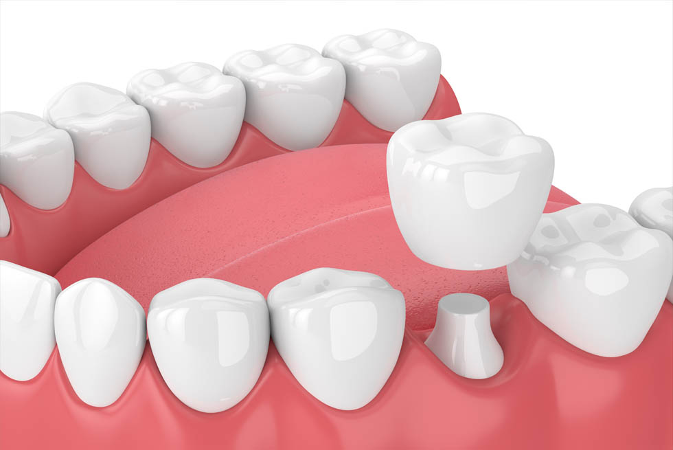 dental crowns Shildon Smile Care Dental & Implant Centre