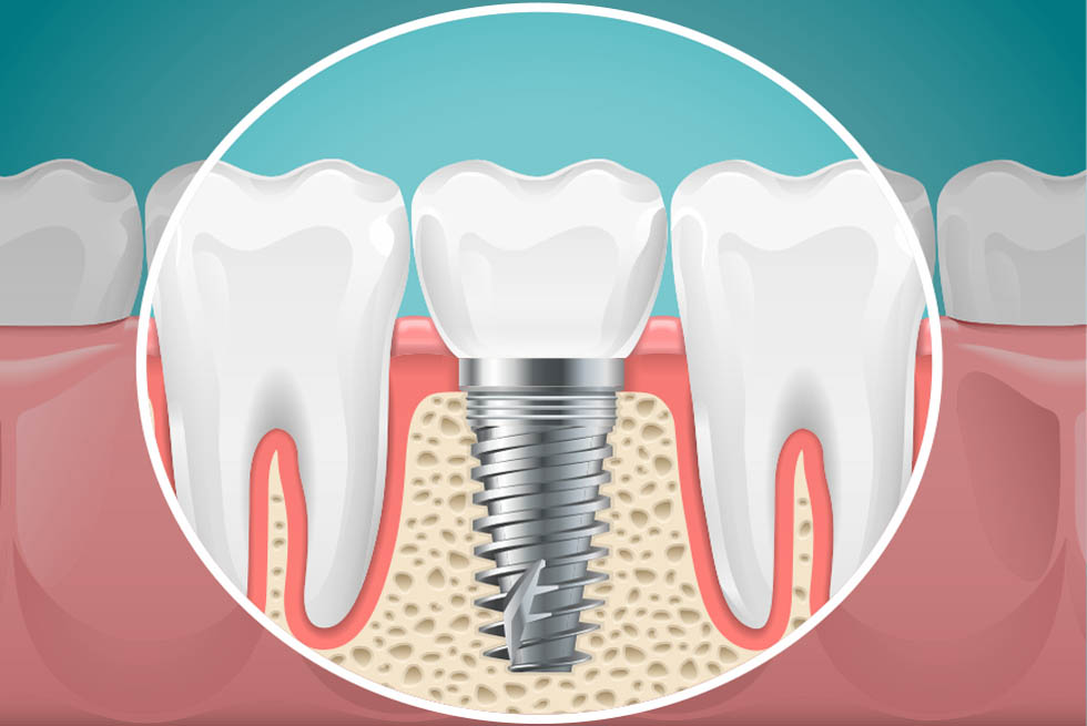 dental implants Shildon Smile Care Dental & Implant Centre