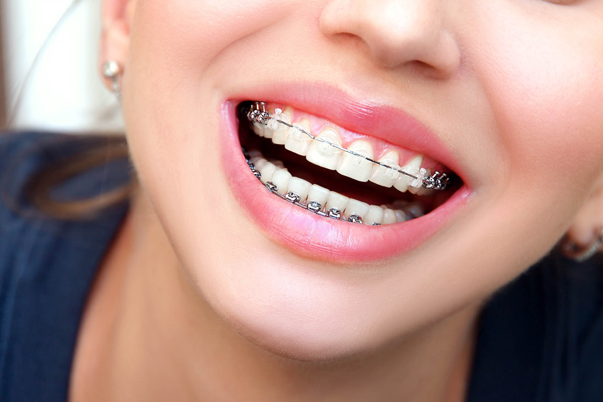 orthodontics Shildon Smile Care Dental & Implant Centre