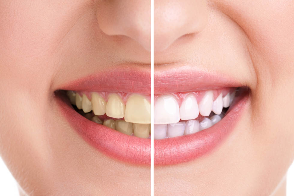 tooth whitening Shildon Smile Care Dental & Implant Centre