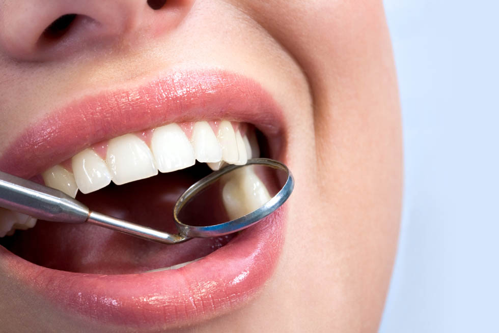 white fillings Shildon Smile Care Dental & Implant Centre